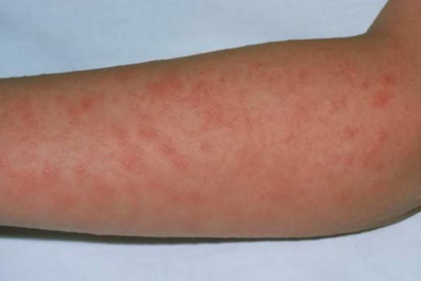 Scarlattina - braccio con eruzione cutanea