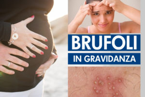 Brufoli in gravidanza