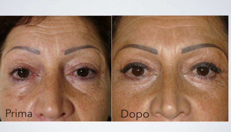 Blefaroplastica prima e dopo intervento