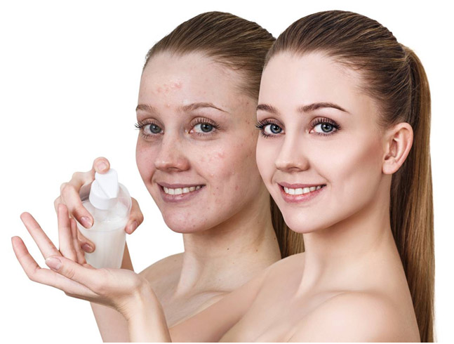 Bava di lumaca per i brufoli