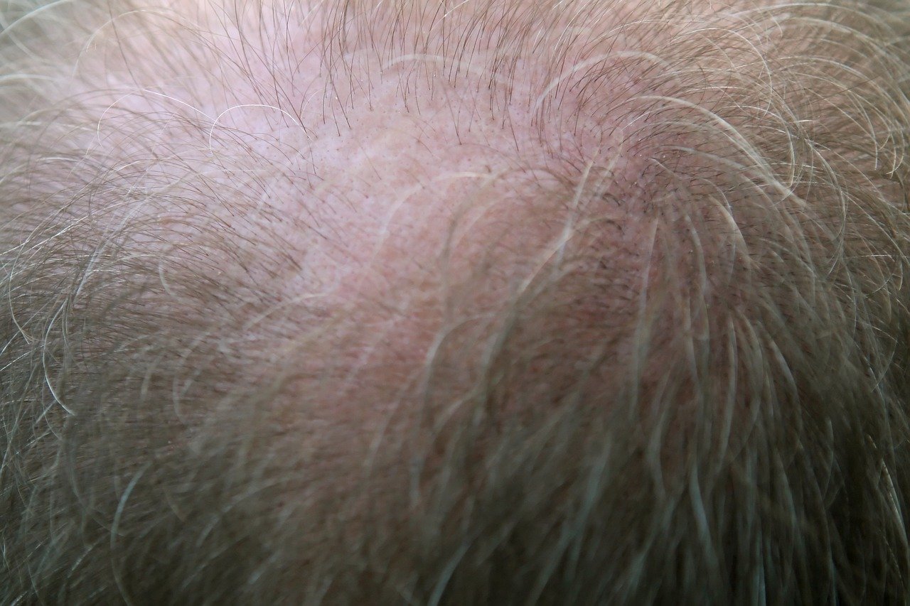 Caduta capelli
