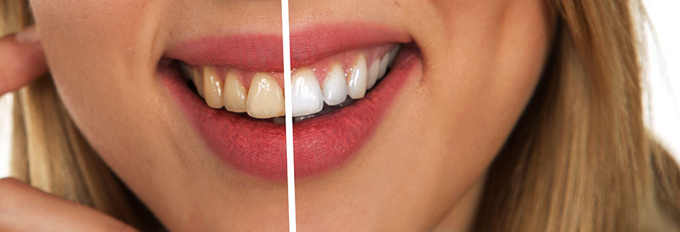 Denti puliti e bianchi a confronto