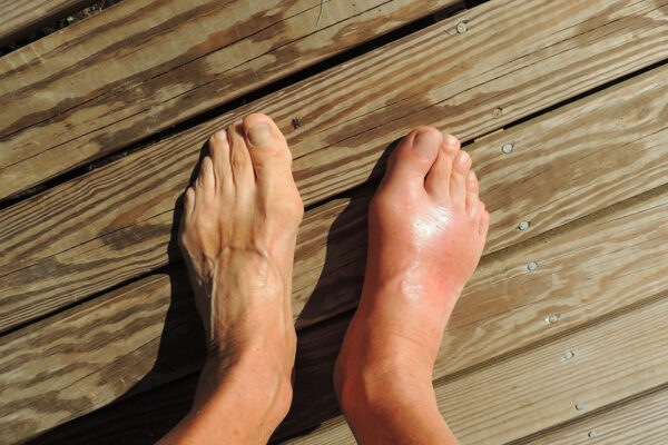 gotta: piedi di un ammalato
